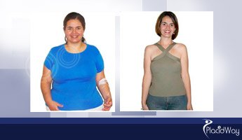 Slider image (8) Cirugia de Obesidad Guatemala - Bariatric Surgery Clinic